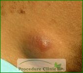 cyst